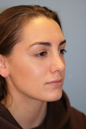 Rhinoplasty: Case 1 - After