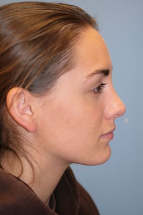 Rhinoplasty: Case 1 - After