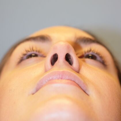 Rhinoplasty: Case 1 - After