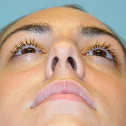 Rhinoplasty: Case 1 - Before
