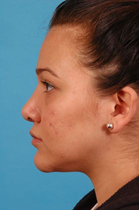 Rhinoplasty: Case 2 - After