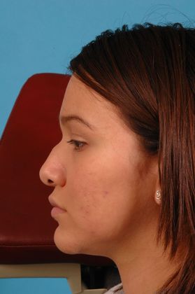 Rhinoplasty: Case 2 - Before