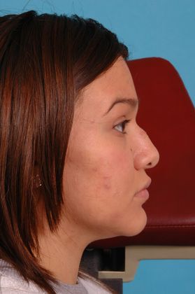 Rhinoplasty: Case 2 - Before