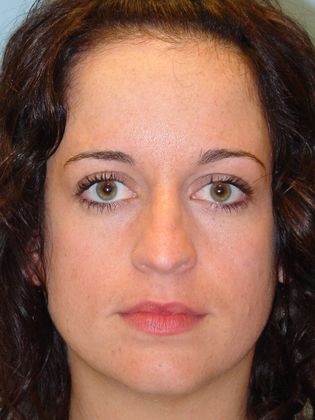 Rhinoplasty: Case 3 - Before