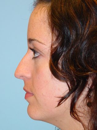Rhinoplasty: Case 3 - Before