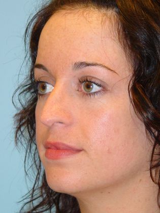 Rhinoplasty: Case 3 - Before