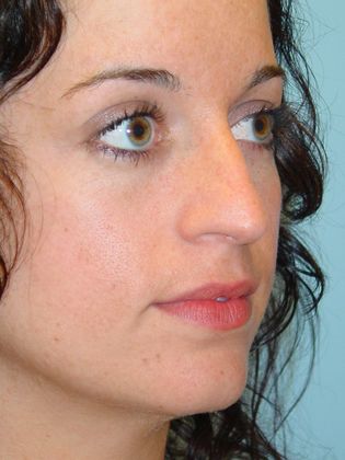 Rhinoplasty: Case 3 - Before