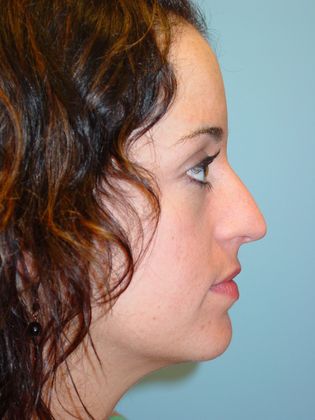 Rhinoplasty: Case 3 - Before