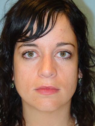 Rhinoplasty: Case 3 - After