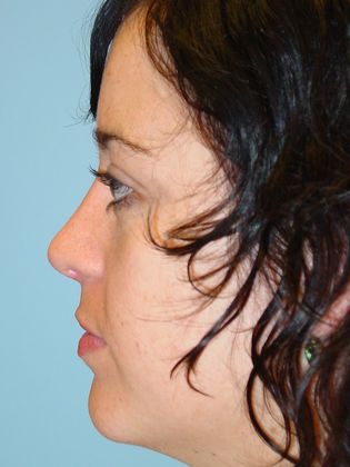 Rhinoplasty: Case 3 - After