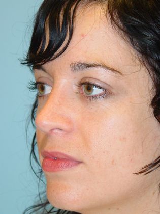 Rhinoplasty: Case 3 - After