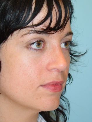 Rhinoplasty: Case 3 - After