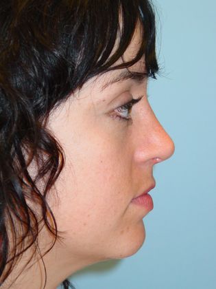 Rhinoplasty: Case 3 - After