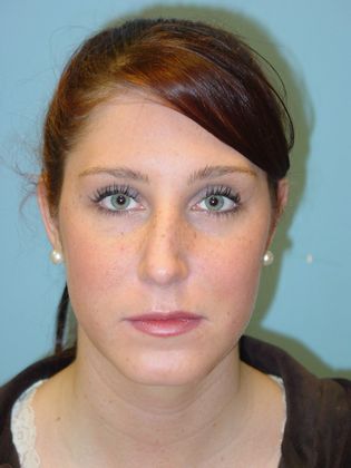 Rhinoplasty: Case 4 - Before