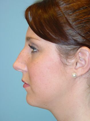 Rhinoplasty: Case 4 - Before