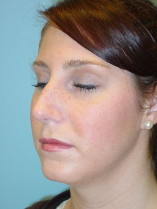 Rhinoplasty: Case 4 - Before