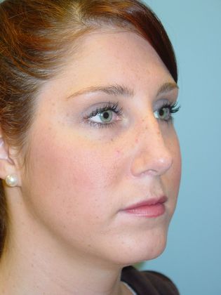 Rhinoplasty: Case 4 - Before