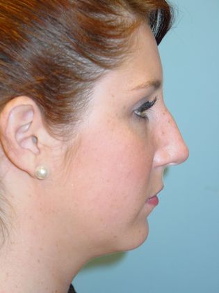 Rhinoplasty: Case 4 - Before