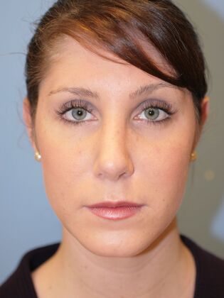 Rhinoplasty: Case 4 - After