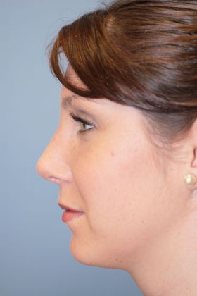 Rhinoplasty: Case 4 - After