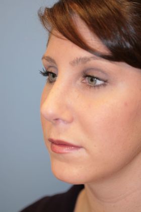 Rhinoplasty: Case 4 - After