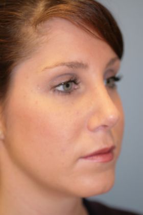 Rhinoplasty: Case 4 - After