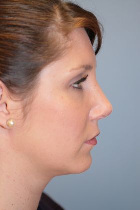 Rhinoplasty: Case 4 - After