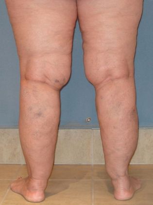 Liposuction: Case 1 - Before