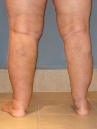 Liposuction: Case 1 - Six Months After
