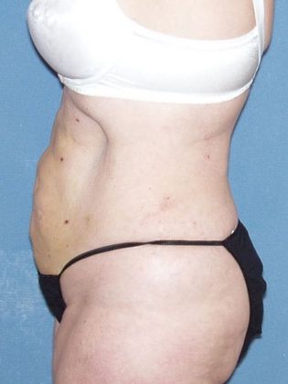 Liposuction: Case 3 - 2 Weeks After - Side