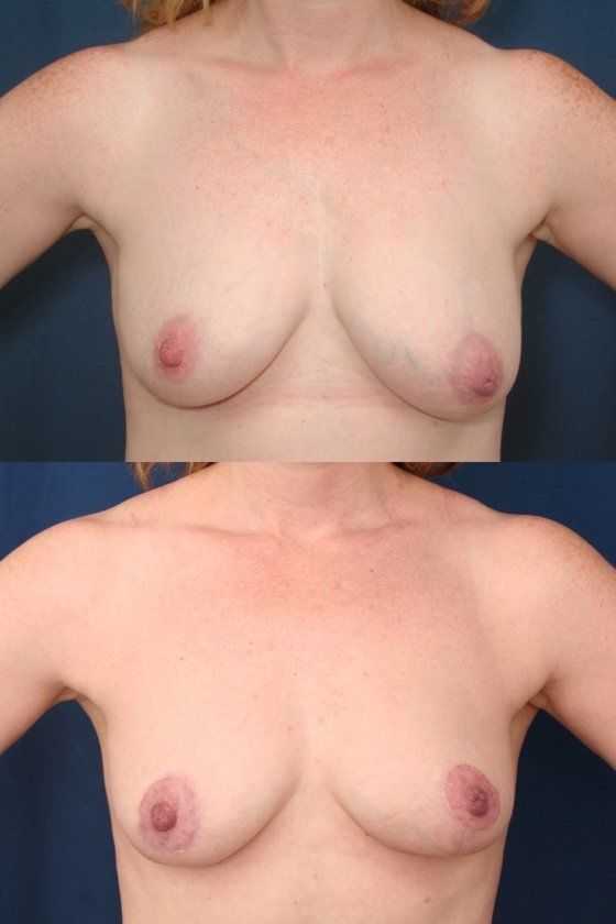 Periareolar Mastopexy