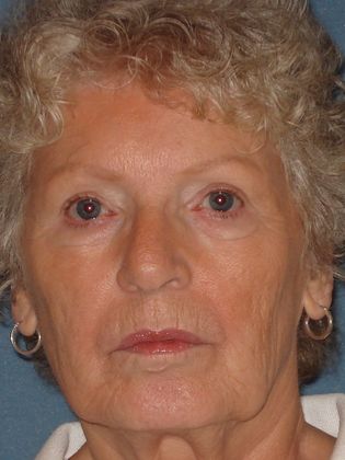 Laser Skin Resurfacing Case 3 - Before