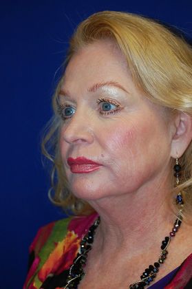 Facial Facelift / Necklift: Case 14 (11456) - Before