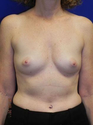 Breast Augmentation  Case 37 (14877) - Before
