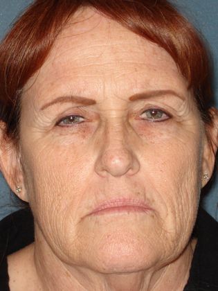 Laser Skin Resurfacing Case 5 - Before