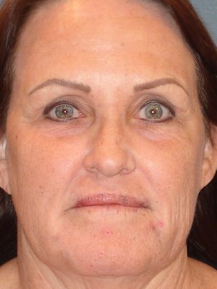 Laser Skin Resurfacing Case 5 - After