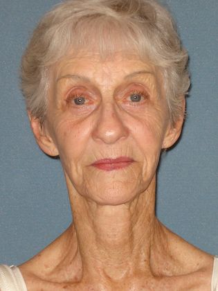 Laser Skin Resurfacing: Case 6 - Before