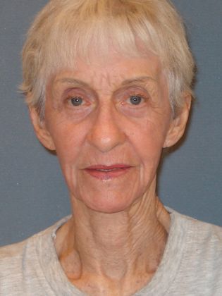 Laser Skin Resurfacing: Case 6 - 6 Weeks After