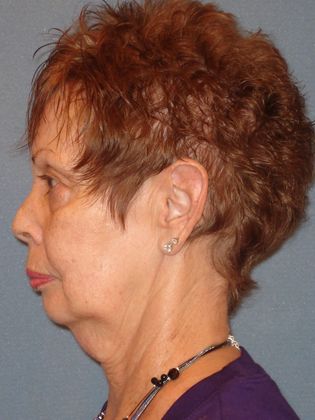 Face & Neck Lifts: Case 6 - Before - Side