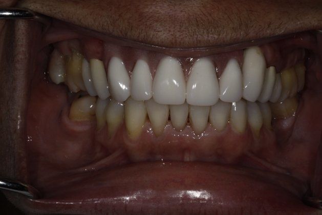Full Mouth Implants Pictures