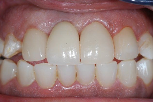 White Gold Teeth Implants