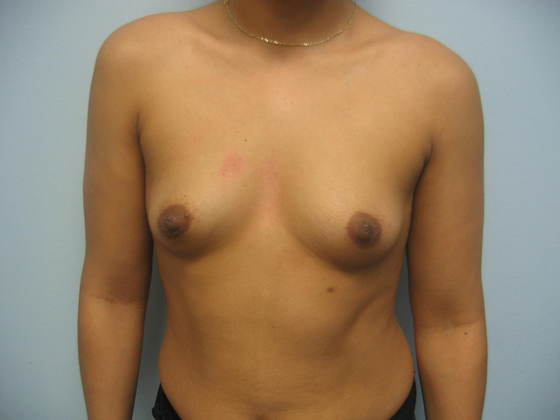 Breast Augmentation: Case 2 - Breast Augmentation Before Frontal View