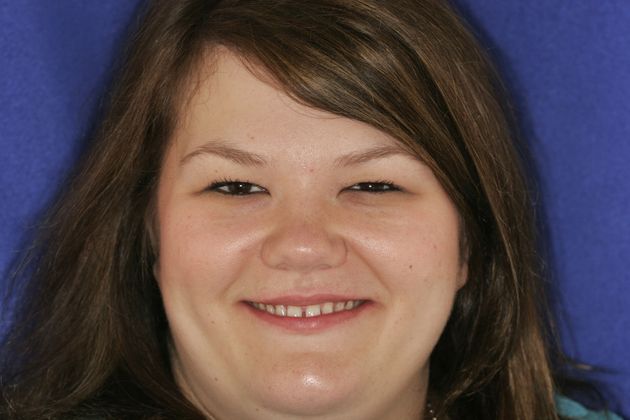 Veneers: Case 1 - Before