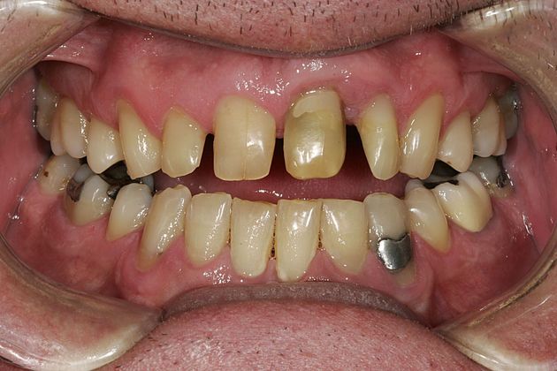 Veneers Case 3 - Before