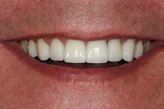 Veneers Case 3 - After