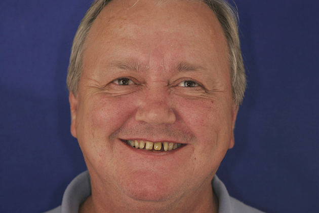 Veneers: Case 3 - Before