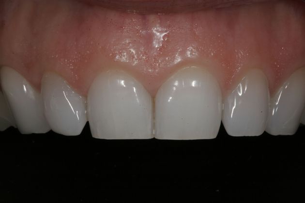 Veneers Case 4 - Before