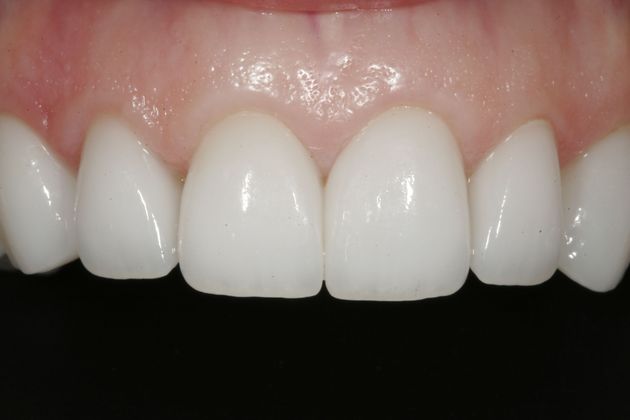 Veneers Case 4 - After