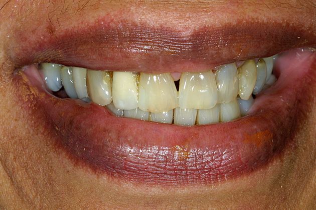 Veneers Case 5 - Before