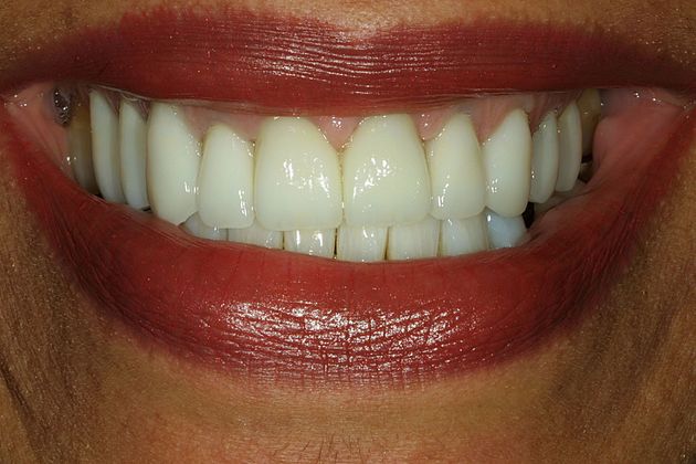 Veneers Case 5 - After